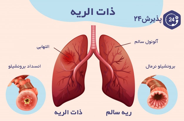 عفونت ریه در کودکان یا پنومونی